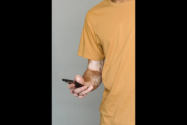 man suffering from vitiligo holding mobile phone