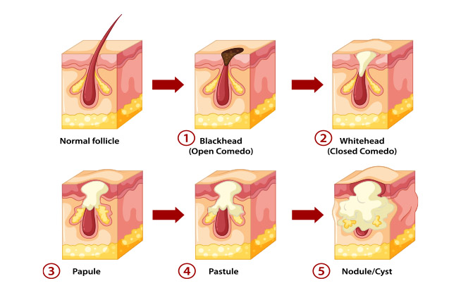 stages of acne - black seed oil benefits for your face article