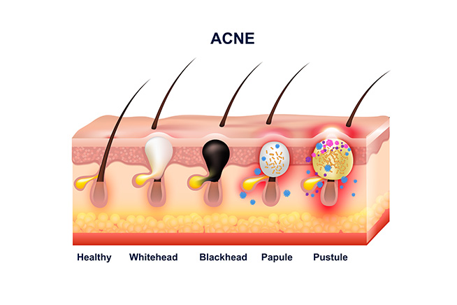 type of acne pimples - black seed oil for your face article - prestige provisions