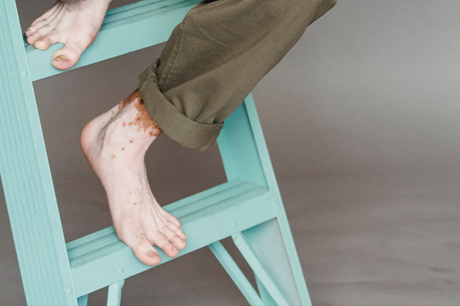 man suffering from vitiligo on ladder