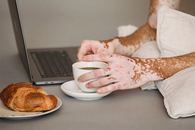 man suffering from vitiligo