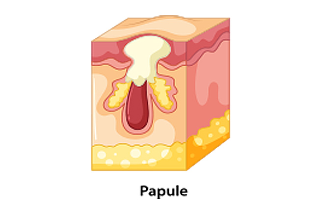 papule acne diagram